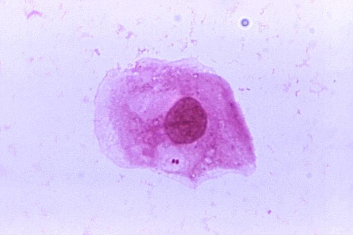 A photomicrograph of Neisseria meningitidis recovered from the urethra of an asymptomatic male; Magnified 1125X (N. meningitidis is responsible for causing "meningococcal" meningococcal. This bacterium is not normal flora, but a pathogenic organism that may be present in a large percentage of the population without causing disease). Keyword: Meningitis