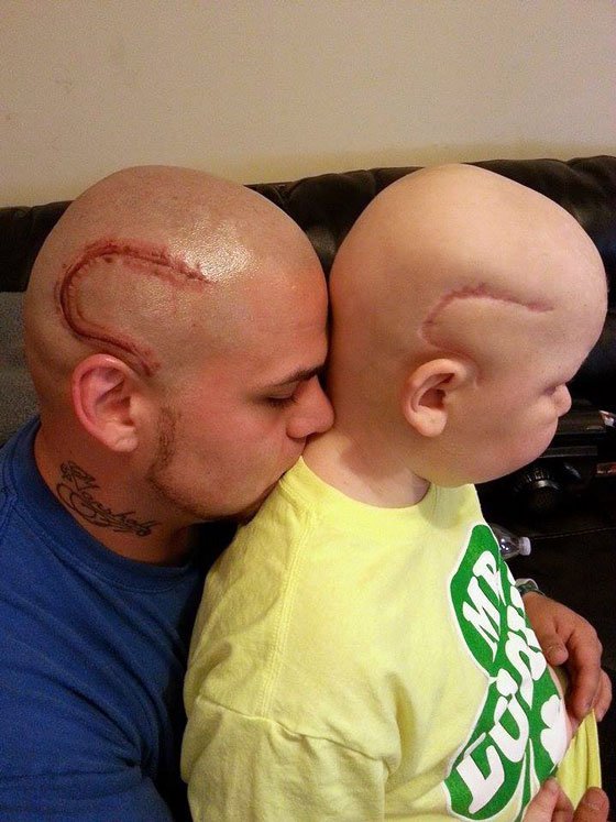 Josh Marshall noticed his young son, who's battling brain cancer, was self-conscious about the scar left behind on his head after a surgery. So Marshall got a tattoo that matches his son's scar. A picture of the head-matching father and son was entered into the #BestBaldDad contest sponsored by the St. Baldrick's Foundation, a childhood cancer charity.
