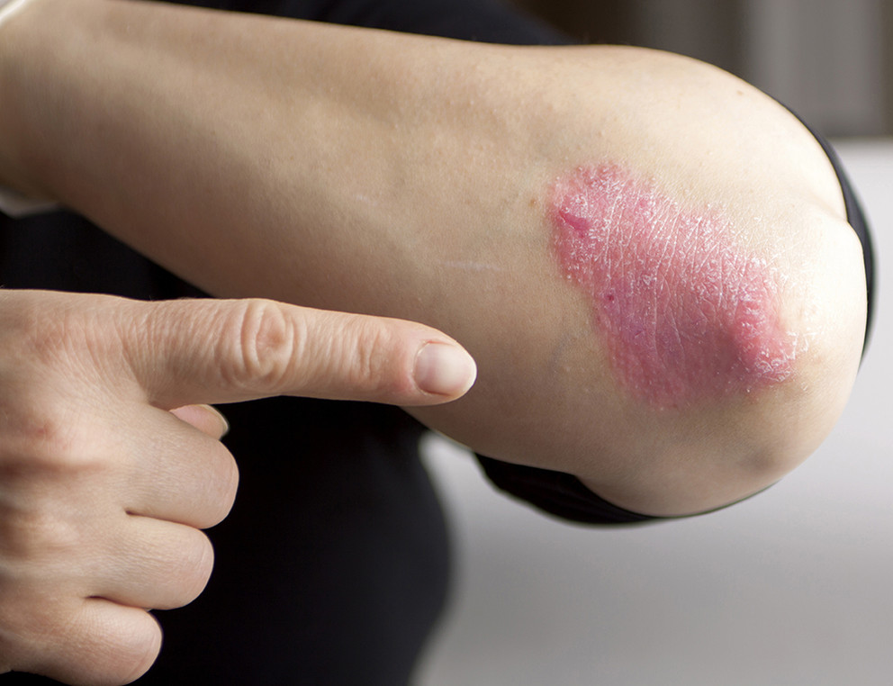 Psoriasis on elbow. Close-up