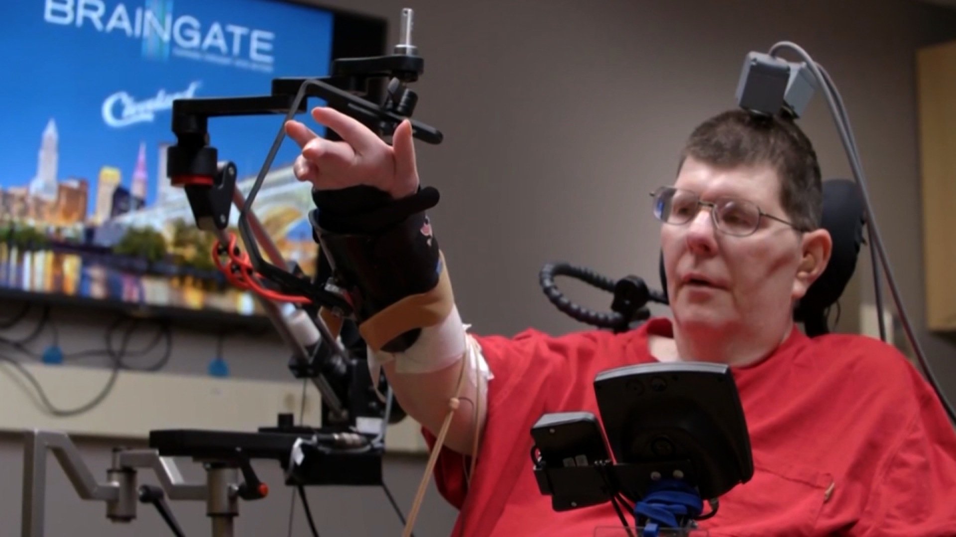 Bill Kochevar has regained use of his right hand with the aid of an experimental prosthetic that replaces lost connections between the brain and the muscles.