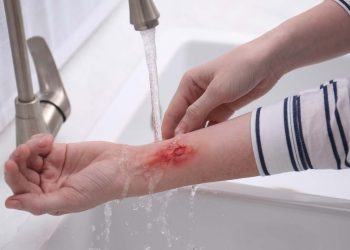 Woman holding forearm with burn under flowing water indoors, closeup