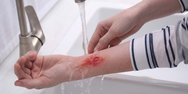 Woman holding forearm with burn under flowing water indoors, closeup