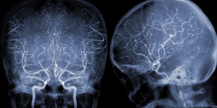 Cerebral angiography  image from Fluoroscopy in intervention radiology  showing cerebral artery.